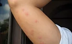 When Bedbugs Bite