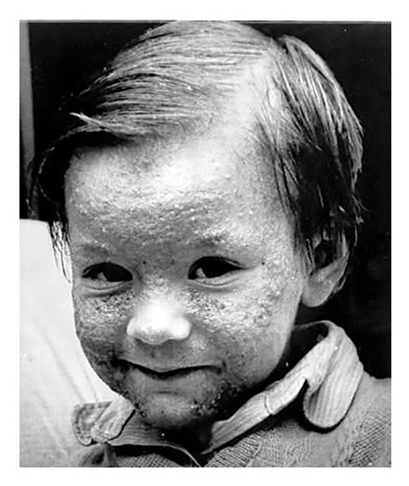 kid with cloracne